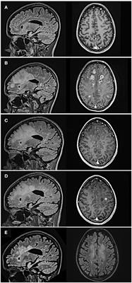 Case Report: Persisting Lymphopenia During Neuropsychiatric Tumefactive Multiple Sclerosis Rebound Upon Fingolimod Withdrawal